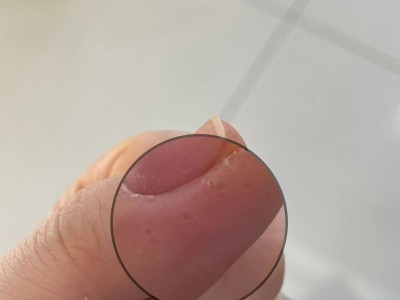 手指上出现小水泡的原因及治疗方法（手指水泡的症状、预防和有效药物治疗方法）